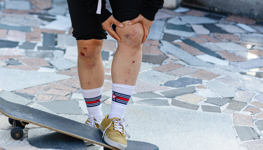 Zapobieganie urazom jest niezwykle ważne w skateboardingu, jeżeli jednak dojdzie do uszkodzenia stawu kolanowego należy od razu wdrożyć suplement z kolagenem rybim.