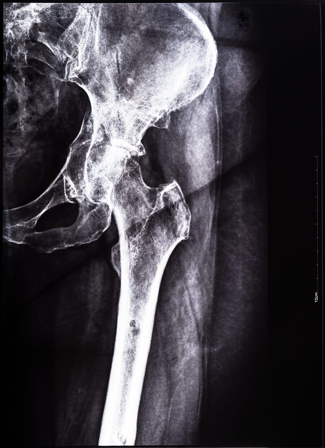 Złamania szyjki kości udowej są dość częste u kobiet po menopauazie które chorują na osteoporozę, ale z pomocą przychodzi hydrolizowany kolagen rybi.